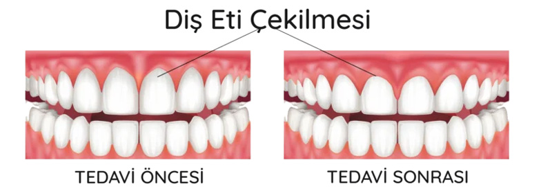 DİŞ ETİ ÇEKİLMELERİ
