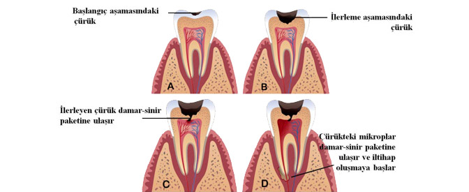 ENDODONTİ (KANAL TEDAVİSİ)